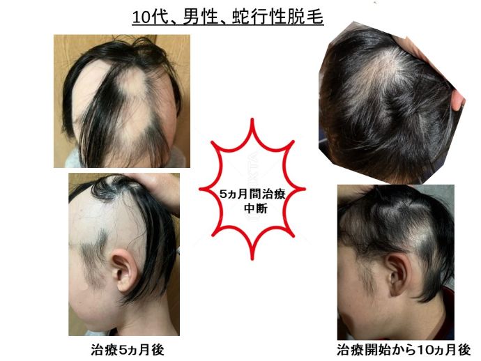 円形脱毛症　病院